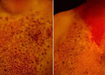 How Pediatric Dermatologists Treat Birthmarks, Warts, and Skin Allergies