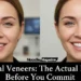 Dental veneers