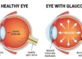 Same eye, one difference: fluid that cannot leave, pressing on a nerve that cannot heal