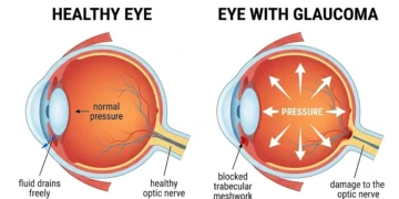 Same eye, one difference: fluid that cannot leave, pressing on a nerve that cannot heal