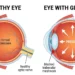 Same eye, one difference: fluid that cannot leave, pressing on a nerve that cannot heal